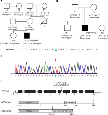 Dilated cardiomyopathy caused by mutation of the PNPLA2 gene: a case report and literature review